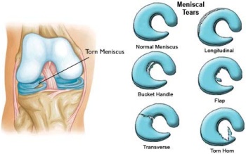 Meniskusschaden Meniskusschaden